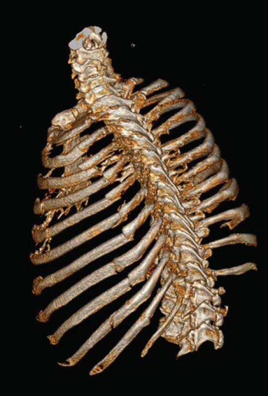 CT 3D reconstruction of serial rib 3 - 10 fracture on the left with
a multiple fracture of ribs 3 - 6 causing instability of the chest wall
