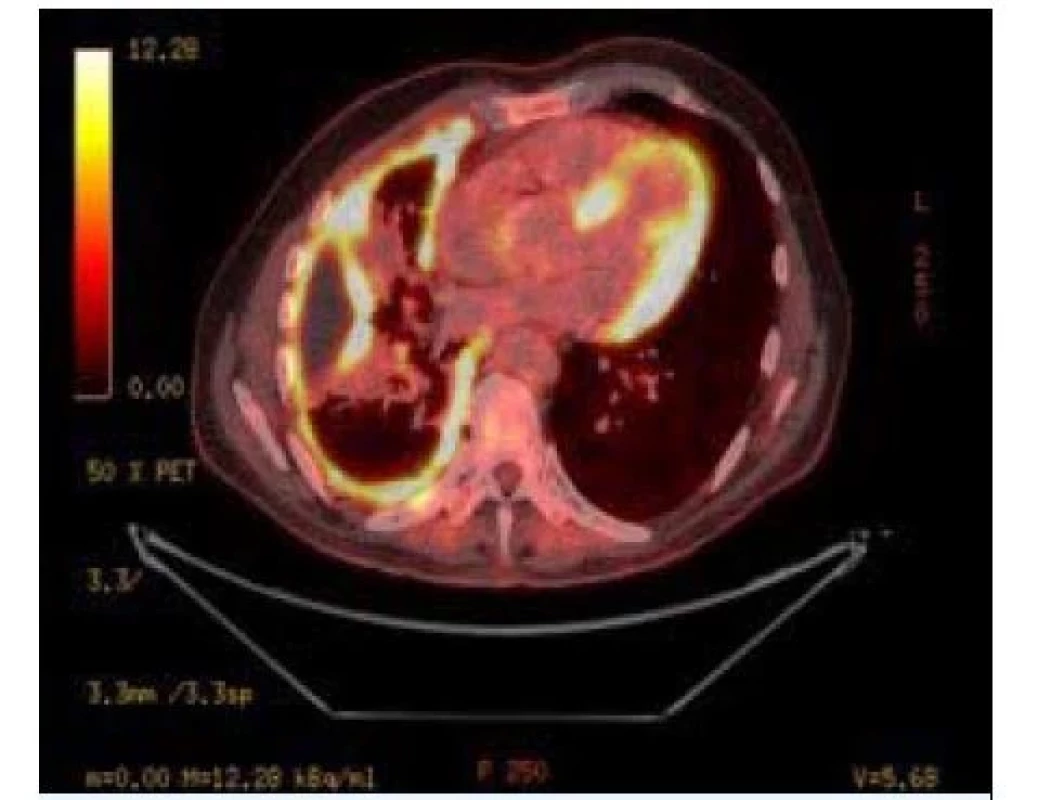 Maligní mezoteliom pleury – zobrazení PET/CT