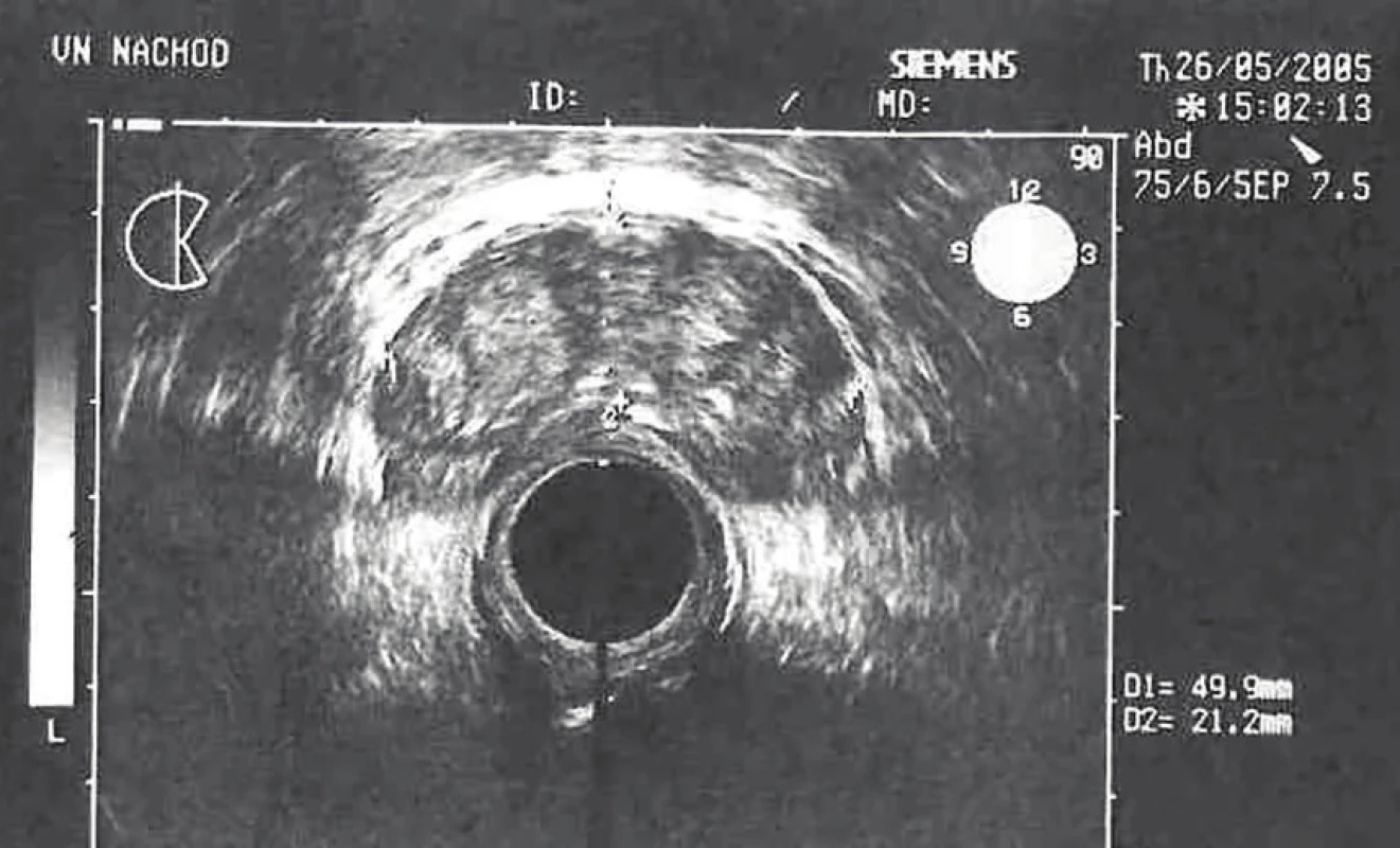 Hyperplazie prostaty s elevací PSA – ultrasonografie<br>
Fig. 2: Benign hyperplasia of the prostate, elevation in
PSA level – ultrasonography
