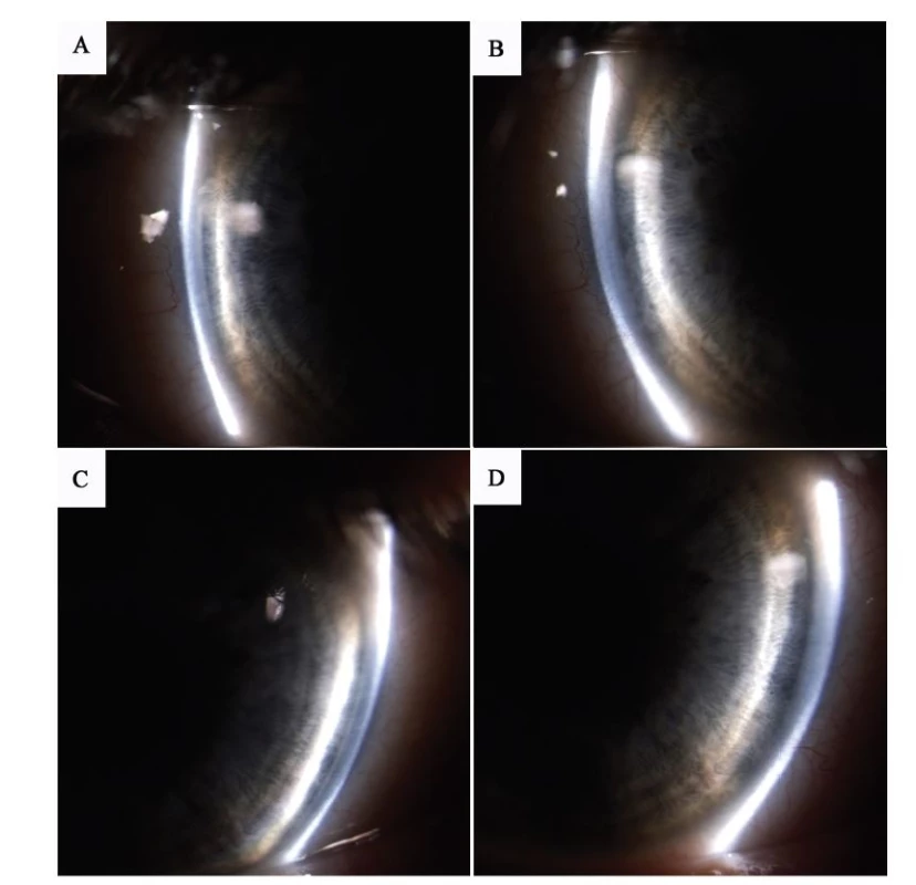 Anterior segment photography – documentation of anterior chamber depth, A) right eye before discontinuation of trazodone, B) right
eye after discontinuation of trazodone, C) left eye before discontinuation of trazodone, D) left eye after discontinuation of trazodone.