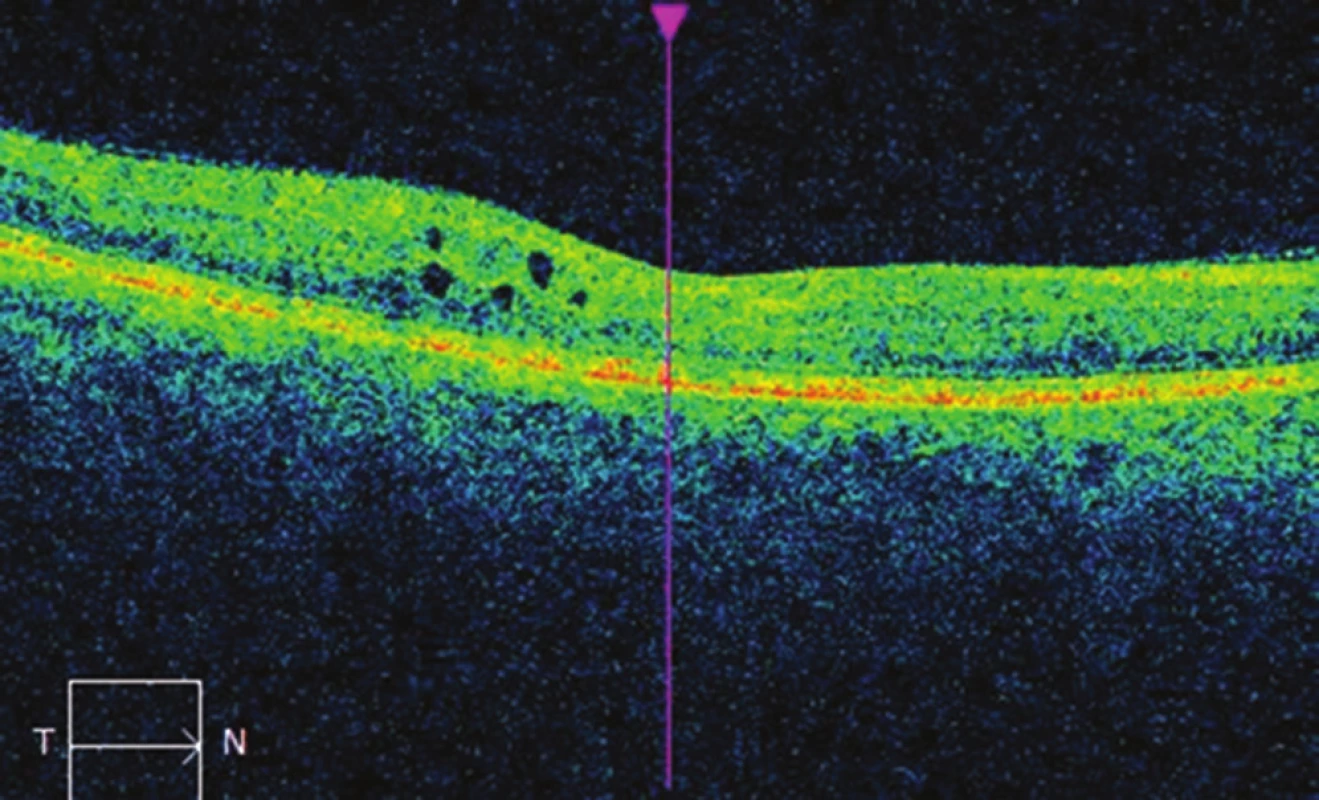 Nález na OCT na pravém oku po ošetření centrální krajiny
mikropulzním laserem: pokles okulárního edému, CRT 266 μm.