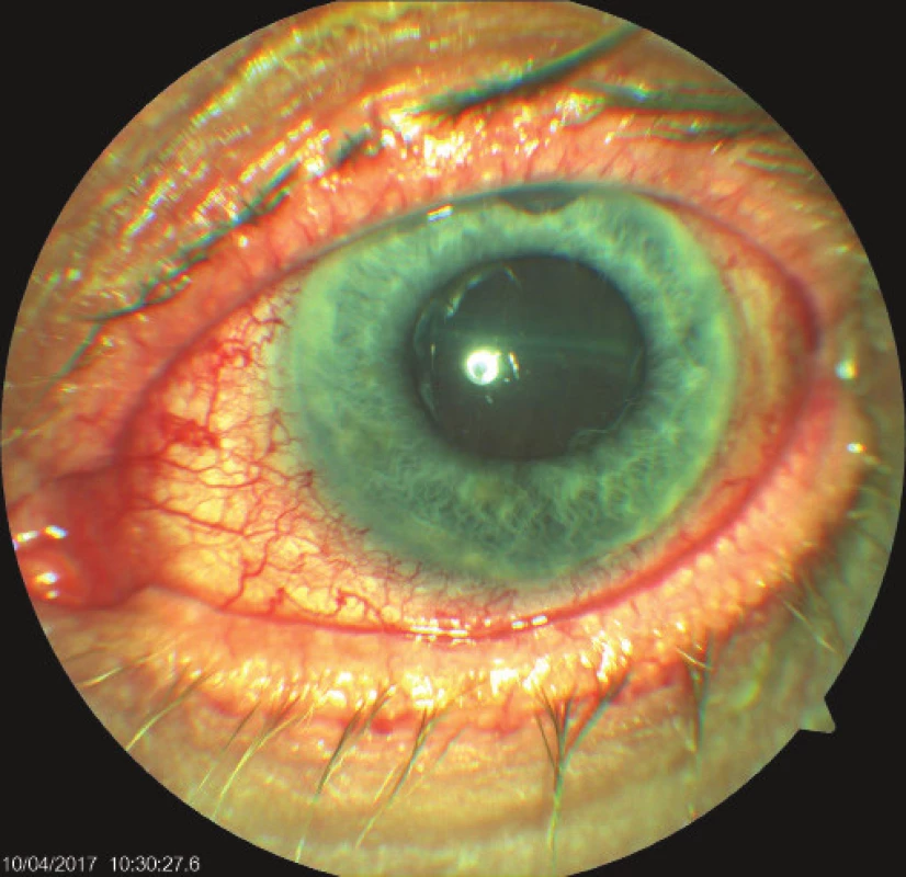 Objective finding in the left eye on 7th day after
trabeculectomy (TE) of LE