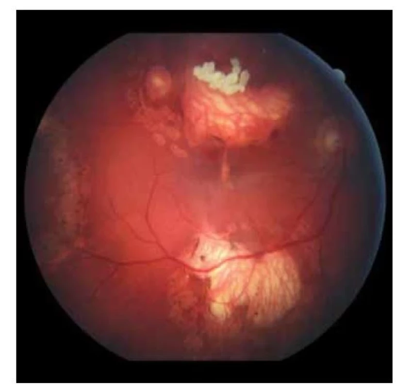 Fundoskopický nález na pravom oku. Početné jazvy
a koraliformné depozity po zhojených tumoroch a fibrotický
prúžok prechádzajúci cez makulárnu oblasť (2019)