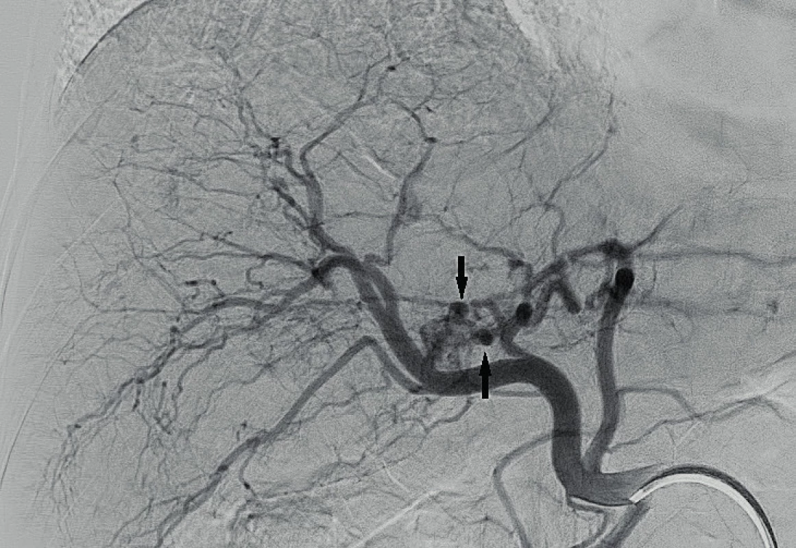 Selektivní angiografie arteria hepatica propria odhaluje
několik drobných promývaných aneurysmat (šipky)