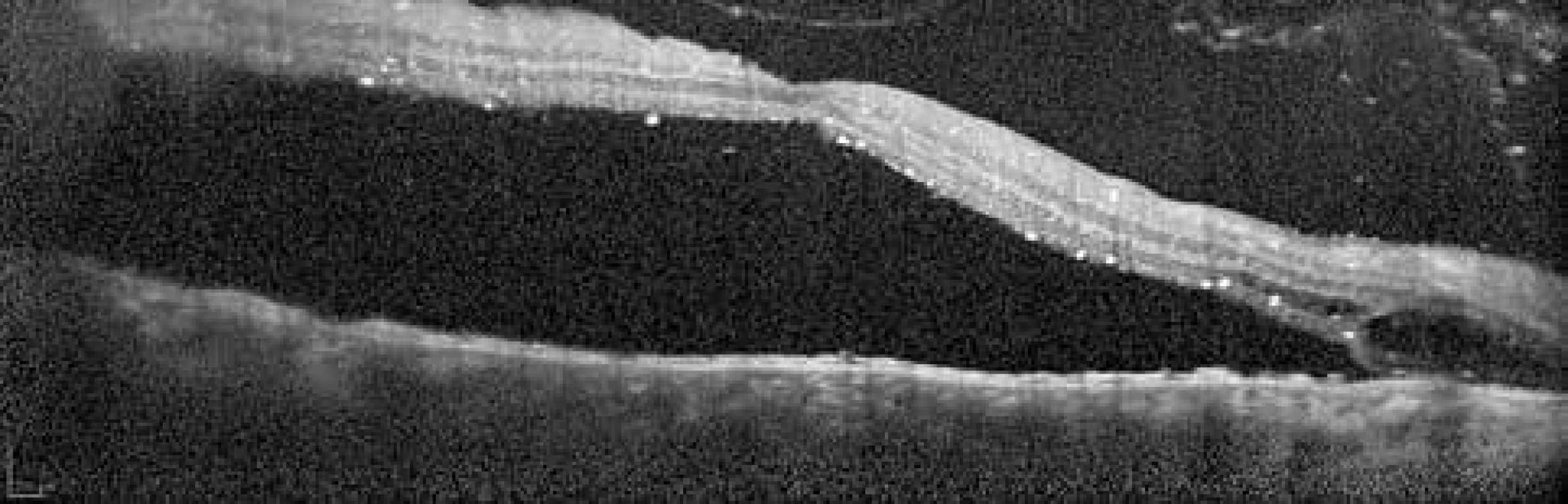Optická koherentní tomografie makuly pravého oka, leden 2018. Neležící makula