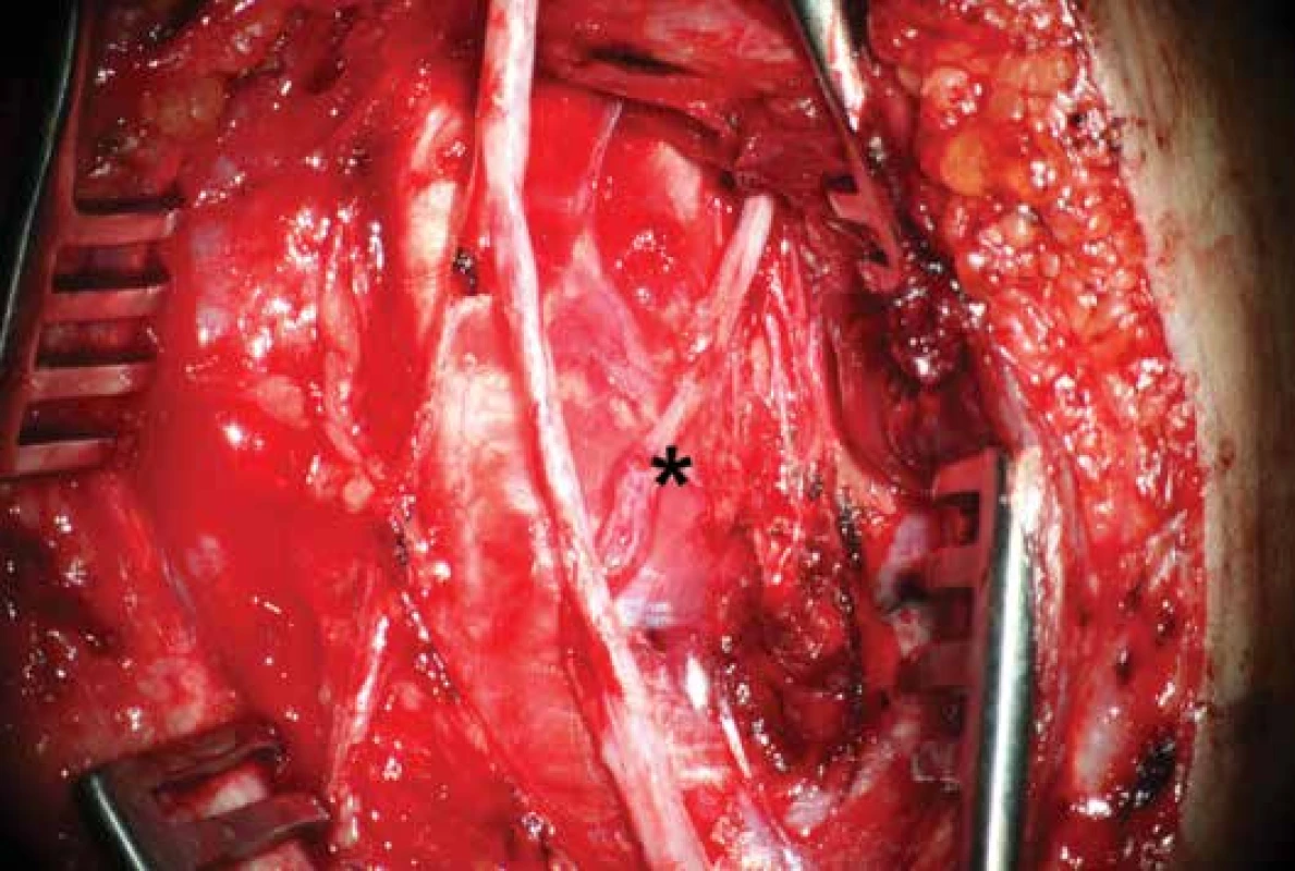 Pohled na dokončenou anastomózu
Přímá mikrochirurgická sutura větve n. interosseus anteberachii anterior na motorickou porci n. ulnaris (*) end-to-end.<br>
Fig. 2: Post-operative view
Direct end-to-end suture (*) of the branch of anterior interosseous nerve of the antebrachium with motor portion of the ulnar
nerve.