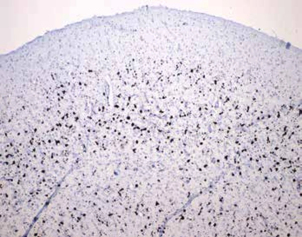 Abnormálne zvýšená prítomnosť makrofágov v hlbších vrstvách
kôry mozgu (farbenie CD68, zväčšenie 100x)