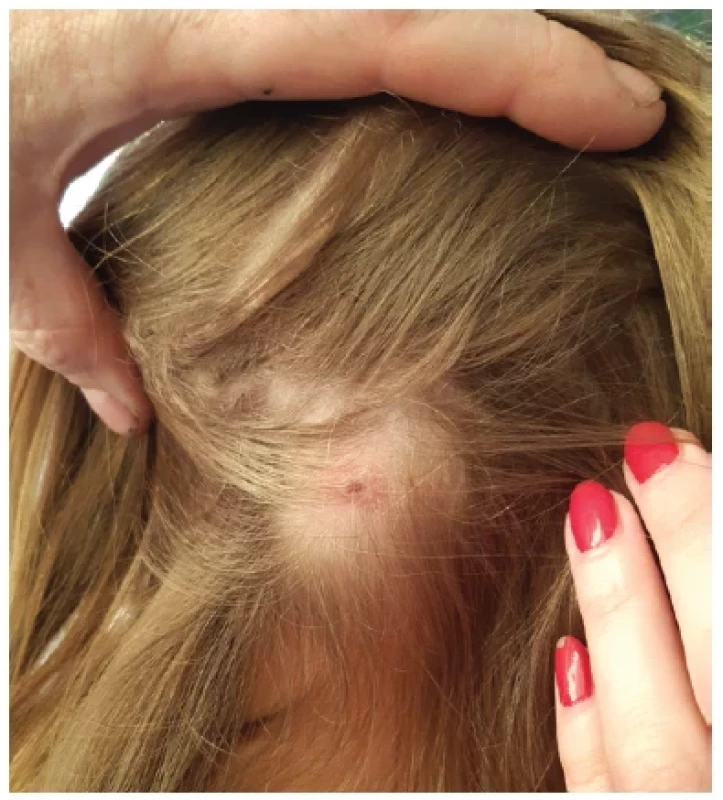 Hnisavé ložisko kůže ve vlasech (pravděpodobné místo
vstupu infekce)
