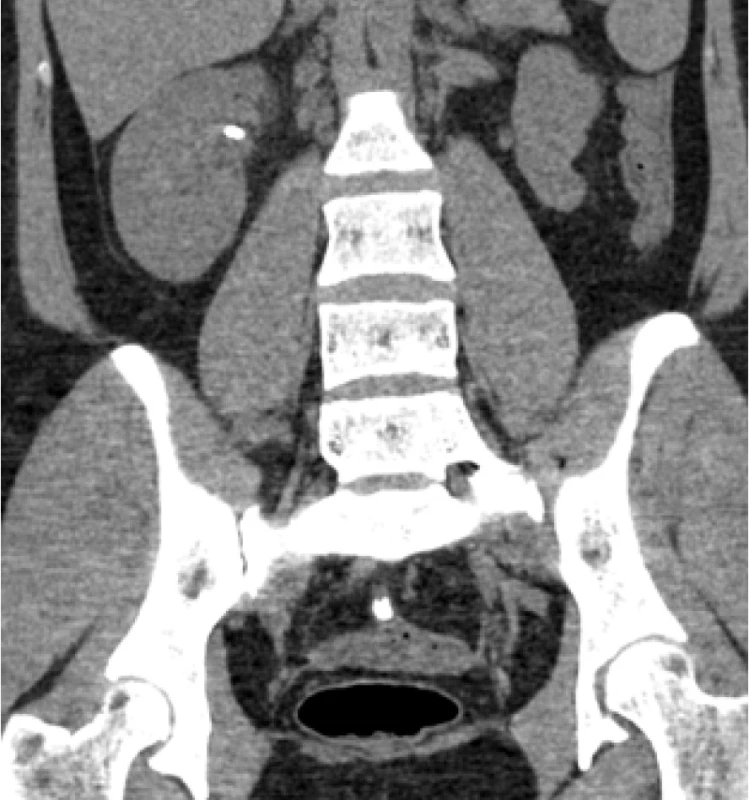 Předoperační nativní spirální CT břicha (šipka
označuje konkrement)<br>
Fig. 1. Preoperative non-contrast helical CT scan (an
arrow showing the stone)