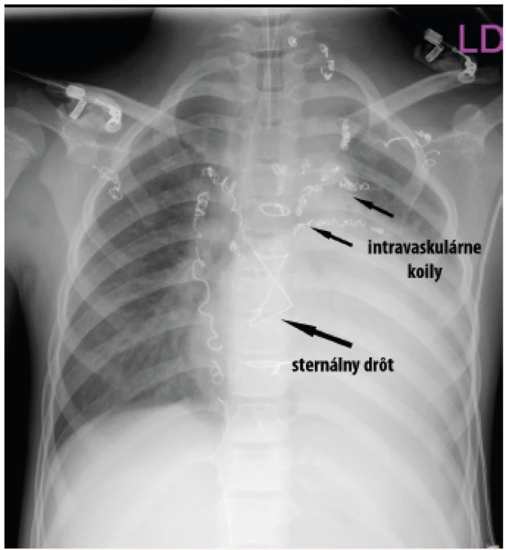 RTG snímka hrudníka po opakovaných stavoch závažnej
hemoptýzy (pacient 2).<br>
Fig. 4. Chest X-ray after repeated episodes of massive hemoptysis
(patient 2).