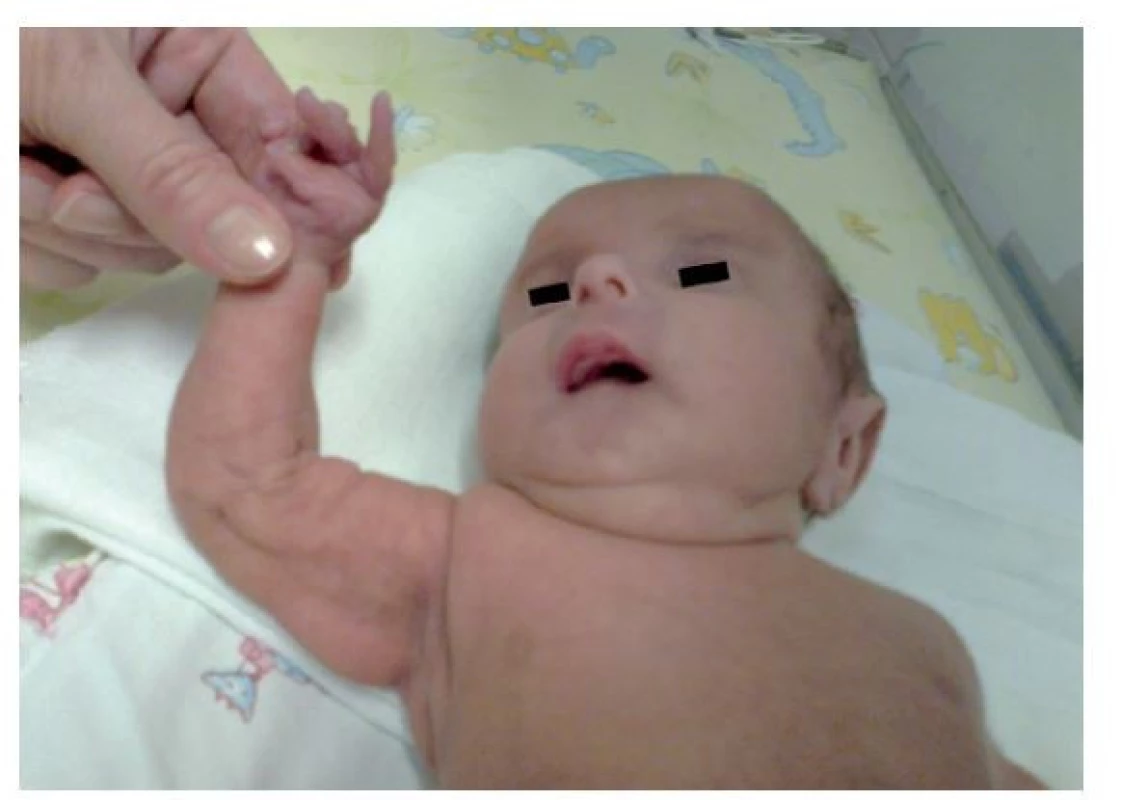 Voľná zriasnená koža so zmenenou kvalitou pozorovaná
v novorodeneckom veku.