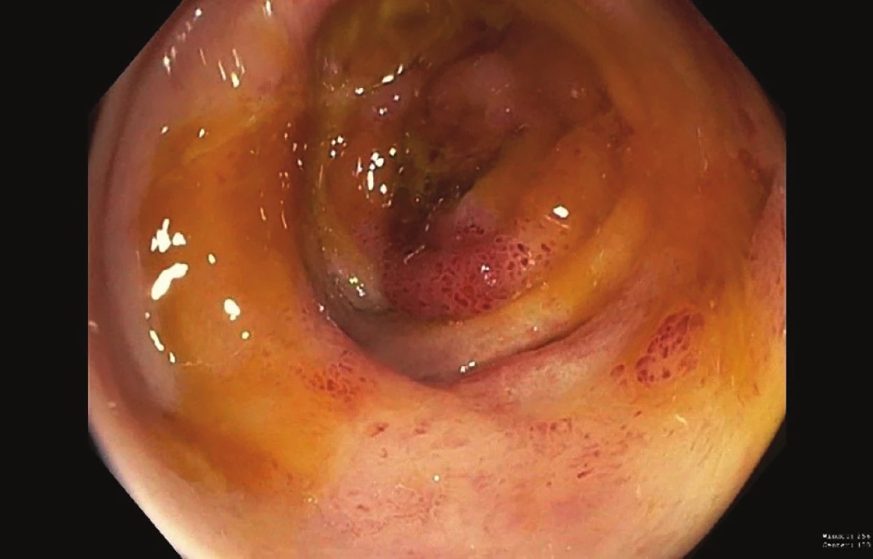 Ischemické vředy na pravém tračníku (kolonoskopie)<br>
Fig. 3: Ischemic right colon ulcers (colonoscopy)