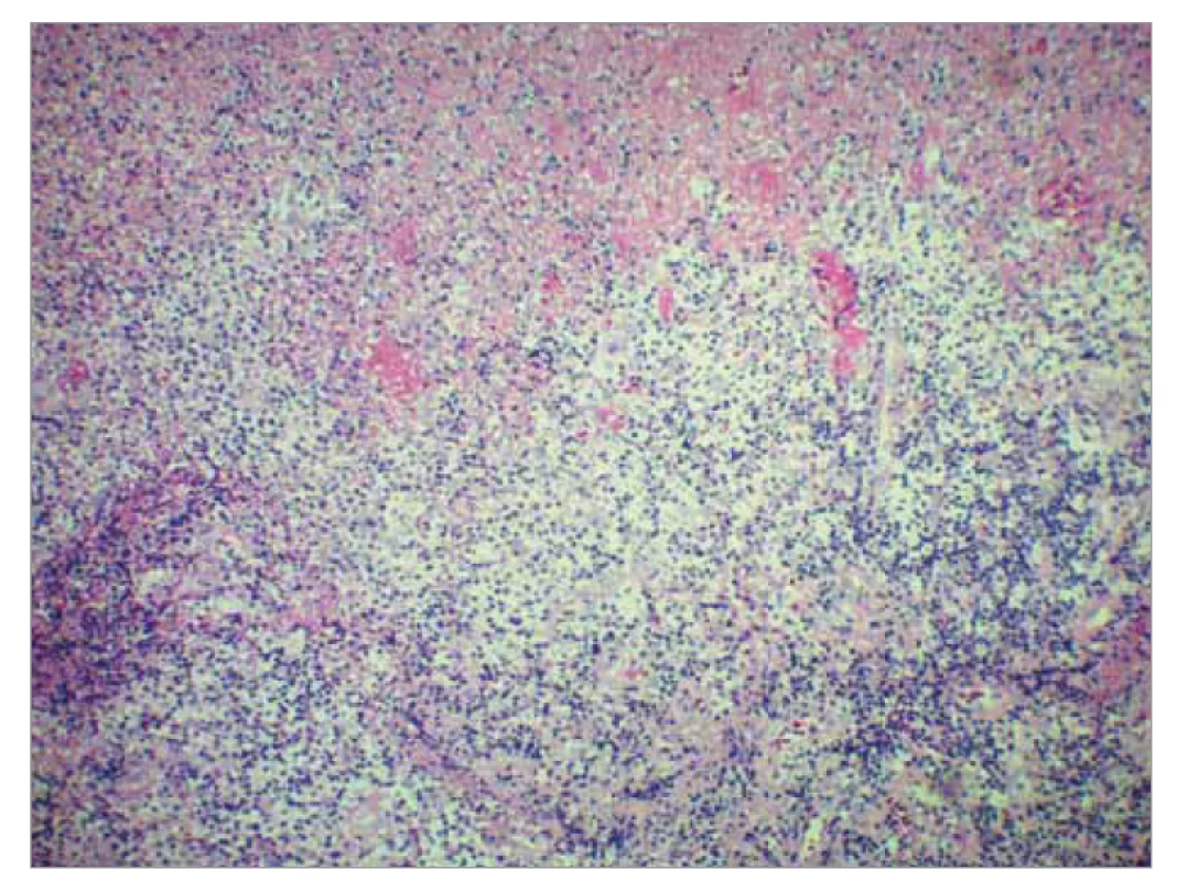 Histomorfologický obraz lymfatického tkaniva s nekrotizujúcou lymfocytohistiocytovou
bunkovou populáciou (farbené hematoxilínom eozínom,
zväčšenie pri obj. 10).<br>
Fig. 4. Histomorphological image of lymphoid tissue with necrotizing lymphocytic
histiocyte cell population (stained with hematoxylin eosin, magnification at
volume 10).