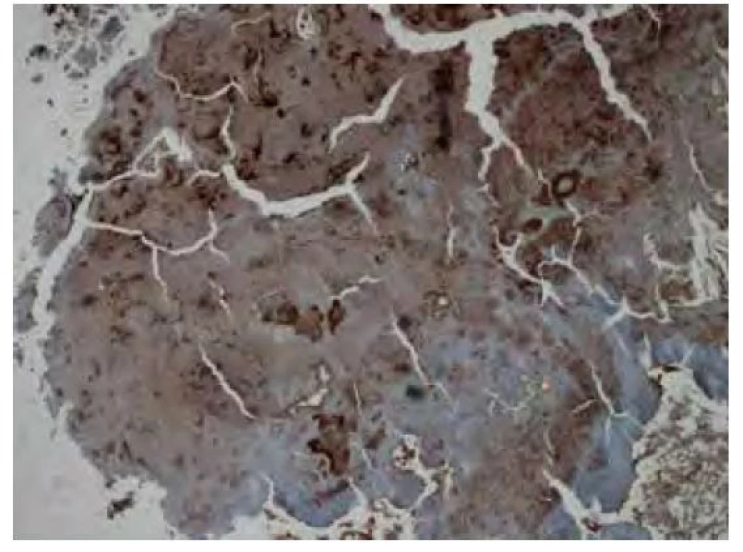 Imunohistochemické vyšetření v reakci s protilátkou proti
transthyretinu vykazuje nepravidelnou fokální převážně středně silnou
pozitivitou amyloidu. Původní zvětšení snímku 40x