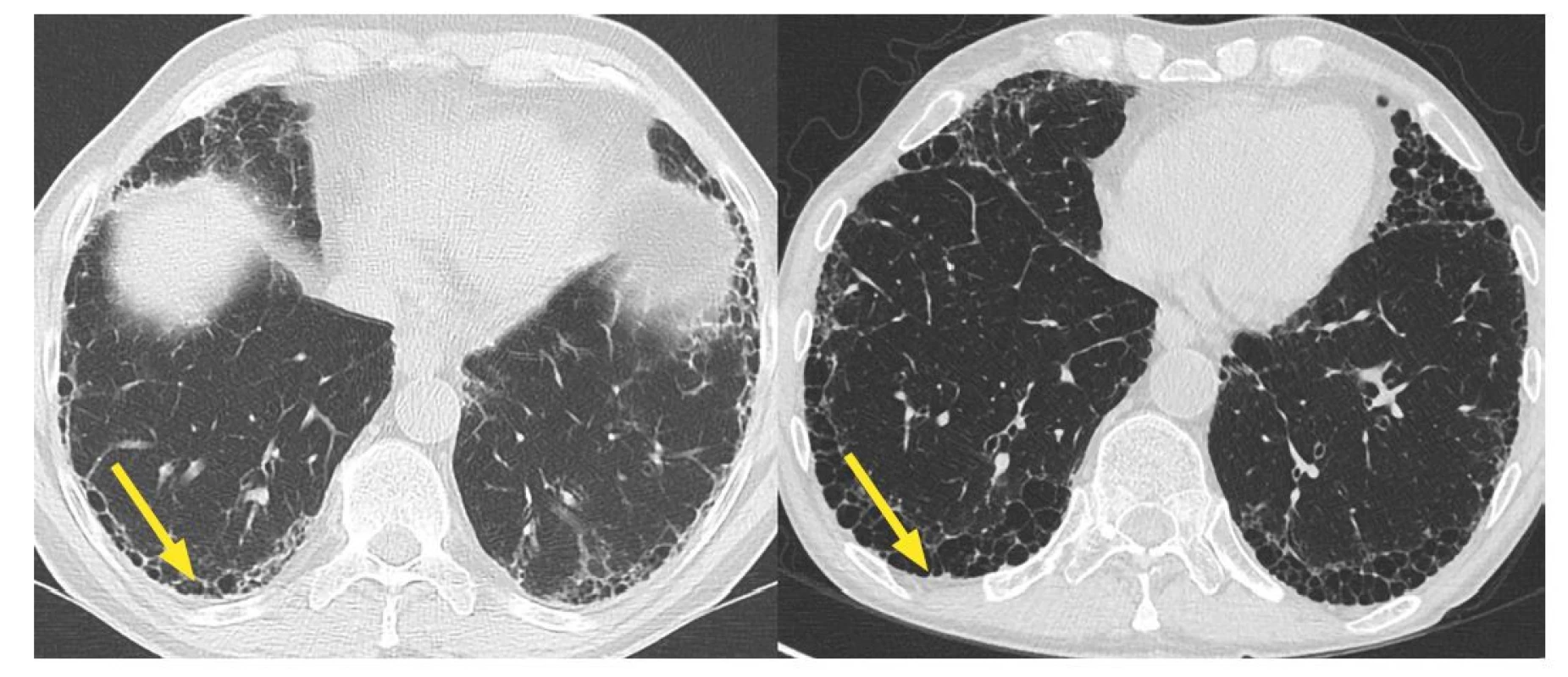 HRCT (výpočetní tomografie s vysokou rozlišovací schopností) hrudníku s nálezem idiopatické plicní fibrózy. Progrese voštinovité přestavby bazálně
subpleurálně v čase (obraz medové plástve).
