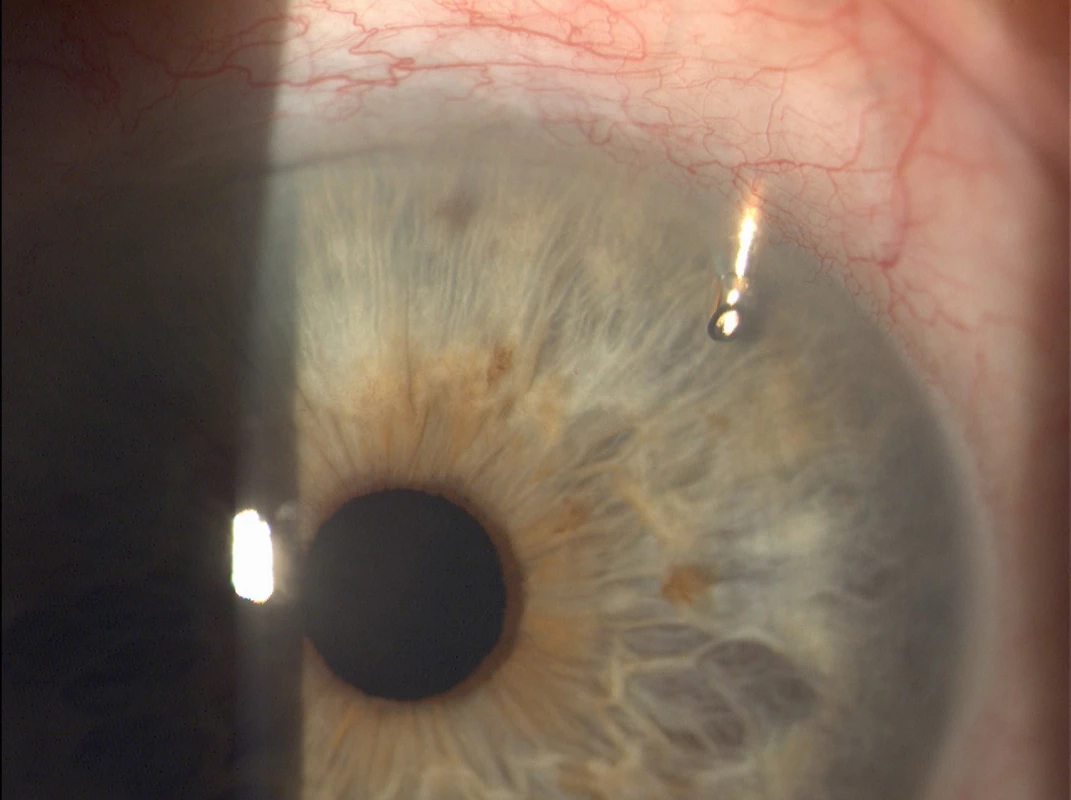EX-PRESS implant located in the upper outer quadrant of the
left eye (Source: own processing, year: 2015)