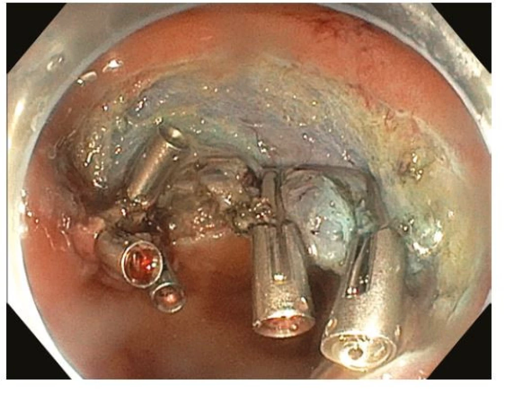 Endoskopická submukózní disekce – spodina po disekci s patrnými
endoklipy nasazenými pro intraprocedurální arteriální krvácení