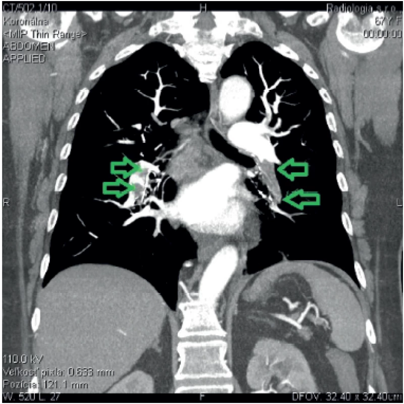 Bilateral embolism into all lobar branches of the pulmonary artery. Arrows pointing towards the emboli