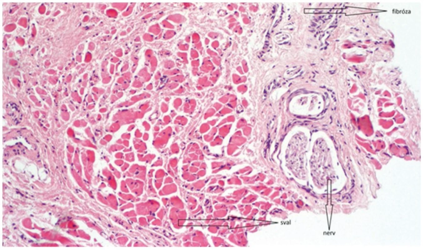 Část podjazykové uzdičky (barveno HE, zvětšeno 100×) zobrazující zejména okrsek příčně pruhované svaloviny, dále je přítomen nerv a fibrózní tkáň<br>
Fig. 3 Part of sublingual frenulum (stained with HE, magnified 100×) showing striated muscle, nerve and fibrous tissue 