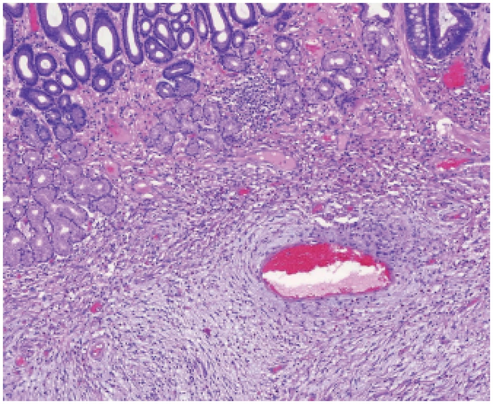 Vaňkův tumor. Pod sliznicí žaludku je patrná proliferace vřetenitých
buněk v edematózním stromatu s příměsí eosinofi lů, která tvoří koncentrické formace okolo cév (HE, 100x).