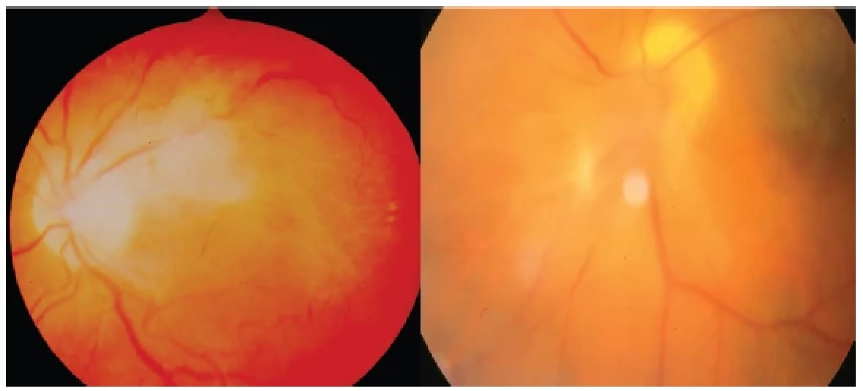 Left: Toxocara granuloma with subfoveolar location inducing CME
Right: Toxocara granuloma with juxtapapillary location accompanied by pronounced vitritis
