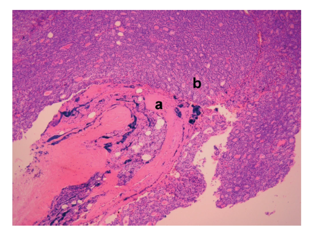 Karcinom příštítného tělíska, zv.100×, barvení HE:
pouzdro afekce (a) destruované nádorovou infiltrací (b)<br>
(Z archivu MUDr. Traboulsi)<br>
Fig. 2: Parathyroid carcinoma at 100× magnification,
H&E stained: lesion capsule (a) destroyed by tumor infiltration
(b)<br>
(From Dr. Traboulsi´s archive)