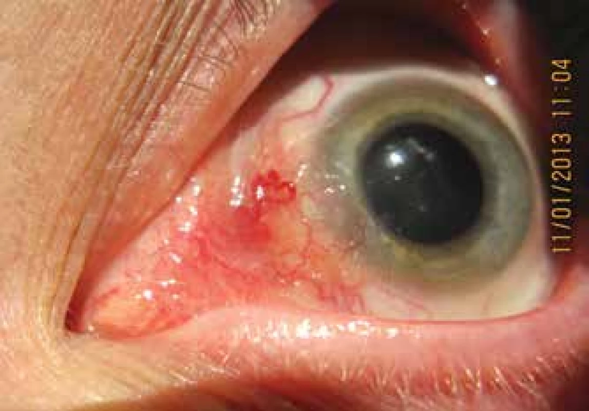 Clinical picture of a patient with inverted type of conjunctival
papilloma in the nasal section of the bulbar conjunctiva (1/2013)