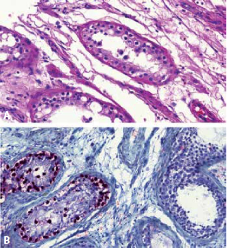 Germinální tubuly s pagetoidním šířením GCNIS. Nádorové buňky připomínají buňky seminomu, mají objemnou světlou cytoplazmu a nepravidelná hranatá jádra (A). Protilátka OCT3/4 je nukleárně pozitivní v tubulech postižených GCNIS, v nenádorových tubulech je negativní (B).