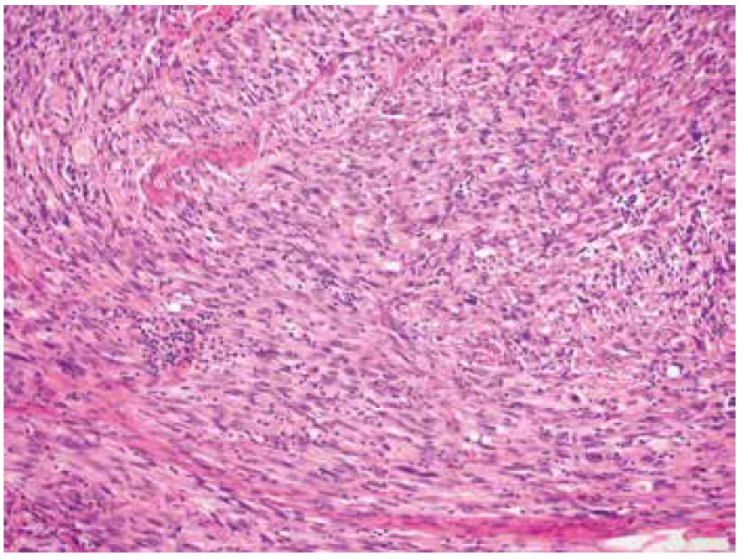 Ložisková mírná lymfocytární infiltrace nádorové tkáně (HE, 200x).