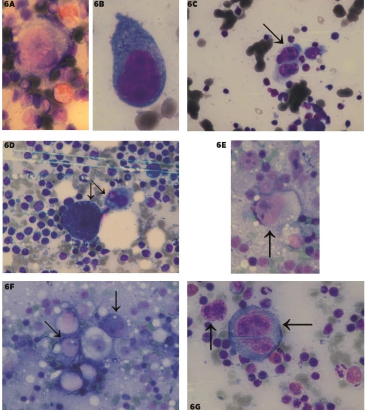 Porovnanie Hodgkinovych buniek a Sternberg-Reedovej (SR) buniek pri klasickom HL a buniek podobných Hodgkinovym bunkám
pri metastázach pri zväčšení 1000x<br>
6A–B – Hodgkinove bunky, 6C–D Sternberg-Reedovej bunky, 6E–F – MTS klasického seminómu, s reaktívnym okolím, 6G – metastáza
veľkobunkového epidermoidného karcinómu s reaktívnym okolím. Predmetné bunky sú vyznačené šípkami.