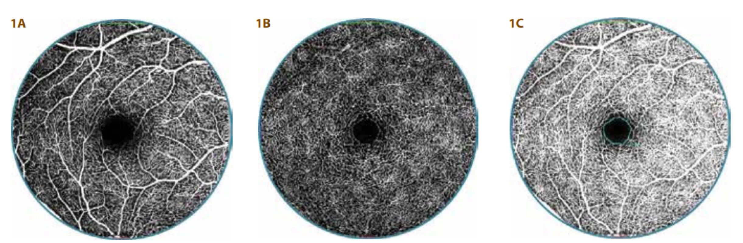 OCT-A vyšetření zdravé 24leté ženy<br>
A. Povrchový vaskulární komplex (SVC) s pravidelnou kapilární sítí<br>
B. Hluboký vaskulární komplex (DVC) s hustou kapilární sítí
a pravidelnou foveální avaskulární zónou (FAZ)<br>
C. Pravidelná, ohraničená a  okrouhlá FAZ (vyznačená modře)
velikosti 0,28 mm² 