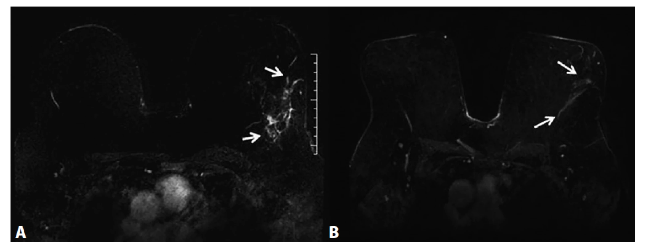 MRM, T1FS ax, kontrastní studie VIBRANT, 3. postkontrastní sekvence, subtrakce − neložiskové sycení ILC<br>
A) Před NCHT. Neložiskové sycení žlázy (NME) v levém prsu odpovídá maligní infiltraci žlázy (rozsah NME vyznačený
dvěma šipkami). B) Po NCHT. Výrazná regrese patologického NME v levém prsu (vyznačeno dvěma šipkami).<br>
Fig. 4: MRI, T1FS ax, VIBRANT contrast study, 3rd post-contrast sequence, subtraction − non-mass enhancement, ILC.<br>
A) Before NCT. Extensive non-mass enhancement (NME) caudally to the ILC lesion, corresponds to malignant disease
in the gland (the extent of NME of the tumour is depicted by two arrows). B) After NCT. Significant regression of pathological
NME of the left breast (depicted by two arrows).