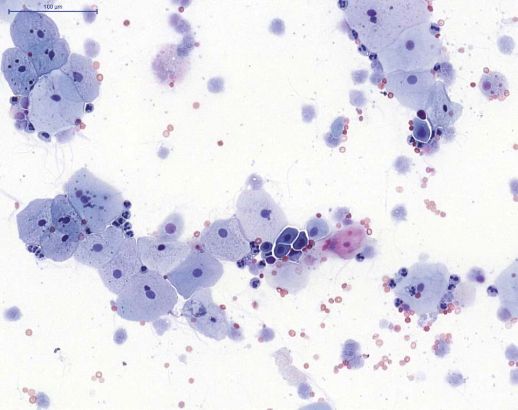 NHGUC (barvení PAP) – přítomny jsou především urotelie povrchové, ojediněle urotelie hlubší (skupina
buněk v centru), na pozadí viditelné neutrofilní granulocyty (segmentované jádro), erytrocyty a autolyticky
změněné blíže nehodnotitelné urotelie<br>
Fig. 1. NHGUC (PAP staining) – superficial urothelial cells and rare deep urothelial cells (group of cells in the
centre) are present, with neutrophils (cells with segmented nuclei), erythrocytes and cytolytic urothelial cells in
the background