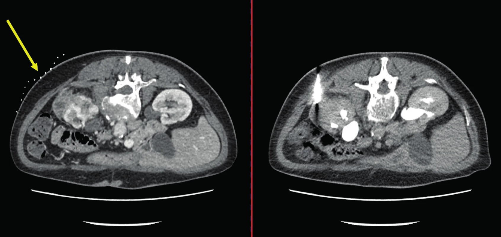 CT, transverzální řez. Žena, 66 let. Vlevo snímek CT před biopsií s popisem solidně-cystického tumoru levé
ledviny a nadledviny s infiltrací retroperitoneálních lymfatických uzlin. Vpravo snímek v průběhu biopsie. Histologicky zánětlivý pseudotumor. Žlutá šipka označuje kontrastní mřížku používanou pro zaměření léze při biopsii<br>
Fig. 3. CT scan, transverse plane. A sixty-six year old female. In the left picture – CT scan prior to the biopsy
with the description of the solid and cystic tumor of the left kidney and adrenal gland with the infiltration of
the retroperitoneal lymph nodes. In the right picture – CT scan during the biopsy. Histologically inflammatory
pseudotumor. Yellow arrow points to the contrast grid which is being used to focus the lession during the biopsy