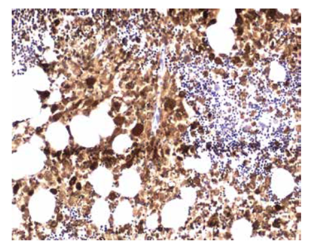 Imunohistochemický průkaz barvení CD68 v gaucherových buňkách
(zvětšení 100x).
