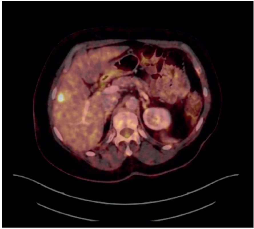 Fúzovaný obraz PET a CT ukazující vysokou metabolickou
aktivitu v ložisku v játrech<br>
Fig. 1. Fused PET/CT image showing high metabolic activity
in the liver lesion