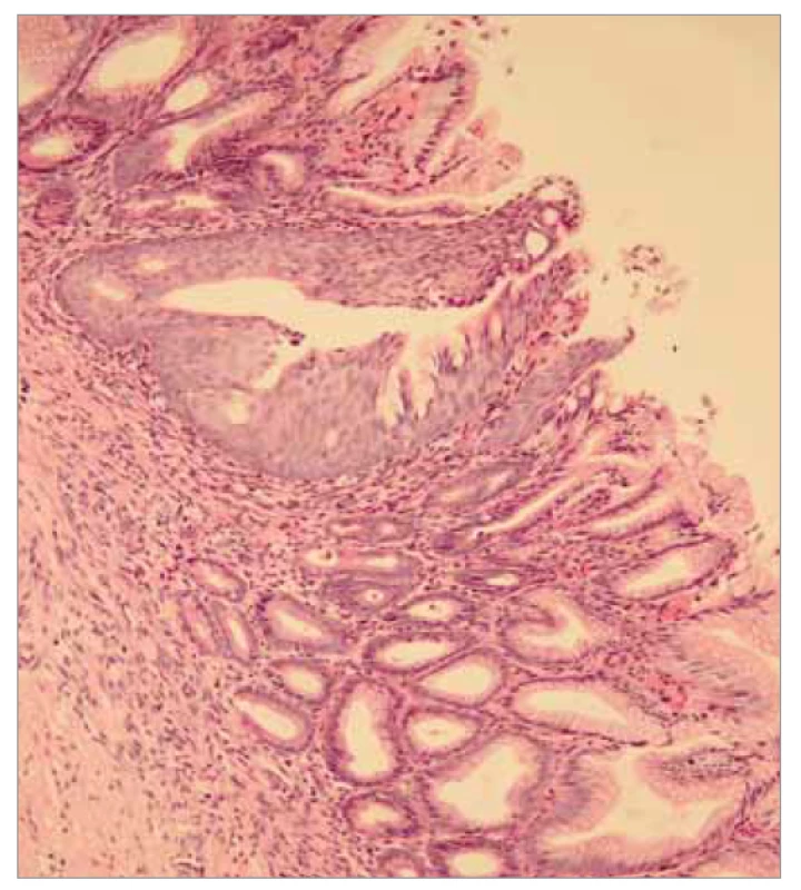 Histopatologický obraz gastrického choristomu 1.
Barvení hematoxylin-eozin, zvětšení 10x.
Na preparátu je patrný epitel víceřadý cylindrický s okrsky
intestinální metaplazie, submukóza a vrstva hladké
svaloviny.<br>
Fig. 4. Histopathological picture of gastric choristoma 1.
Hematoxylin-eosin staining, magnification 10x. The preparation
shows a multi-row cylindrical epithelium with areas
of intestinal metaplasia, submucosa and a layer of smooth
muscle.