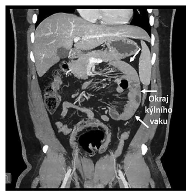 CT dutiny břišní, koronální projekce<br>
Fig. 4: CT of abdominal cavity, coronal projection