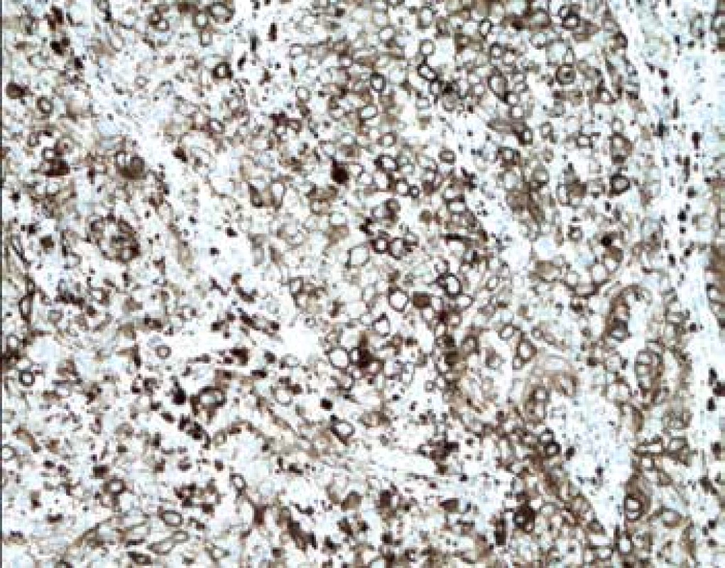 Imunohistochemický průkaz protilátky anti-PD-L1 v nádorových
buňkách melanomu (zvětšení 200x).