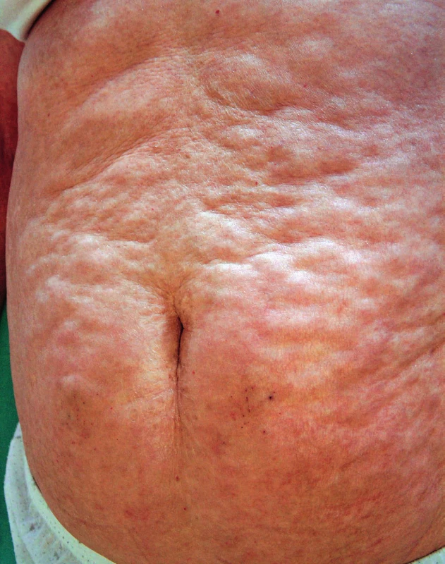 Obraz rozsáhlého postižení v oblasti břicha, typické je
dolíčkování v místech s anatomicky výraznější podkožní tukovou
tkání
