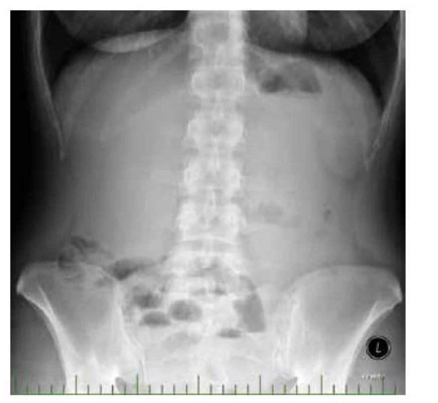 Prostý snímek břicha ve stoje<br>
Fig. 2: Simple abdominal X-ray in the standing position