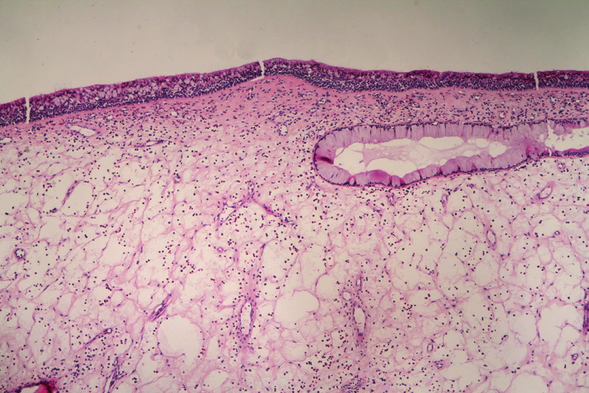 Zánětlivý polyp, hematoxylin-eosin, původní zvětšení
100x. V mikroskopickém obrazu zánětlivého polypu dominuje
výrazný edém s disperzně rozptýlenými zánětlivými buňkami. Na
povrchu je respirační epitel. Vpravo nahoře je průřez vývodem
žlázky s hojnými hlenotvornými buňkami. Tento nález může poněkud
připomínat REAH, ale u polypu se jedná pouze o fokální nález
a hyalinizovaná bazální membrána typická pro REAH zde chybí.