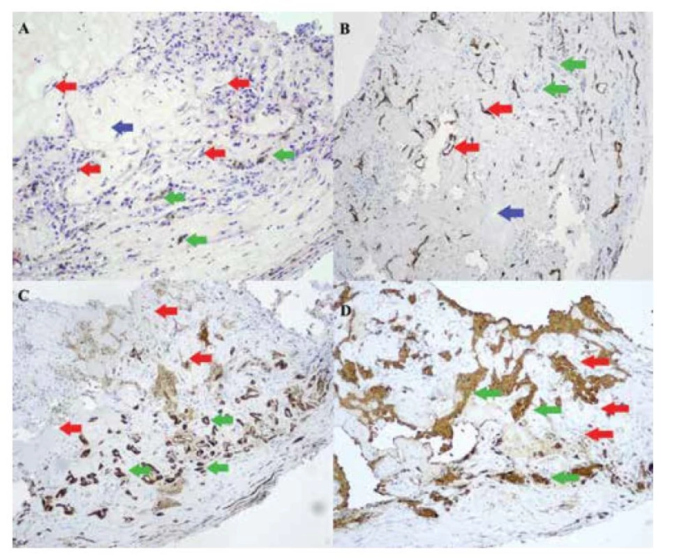 Histologický nález, imunohistochemické farbenie s hematoxylínom – eozínom,
zväčšenie 20x (A), s protilátkou CD 34, zväčšenie 10x (B), s protilátkou S-100, zväčšenie 10x
(C), s protilátkou GFAP (gliálny fibrilárny proteín), zväčšenie 10x (D), červené šípky – vazoproliferácie,
modré šípky – hyalinizovaná stróma, zelené šípky – reaktívna proliferácia gliálnych
buniek s melanínovým pigmentom
