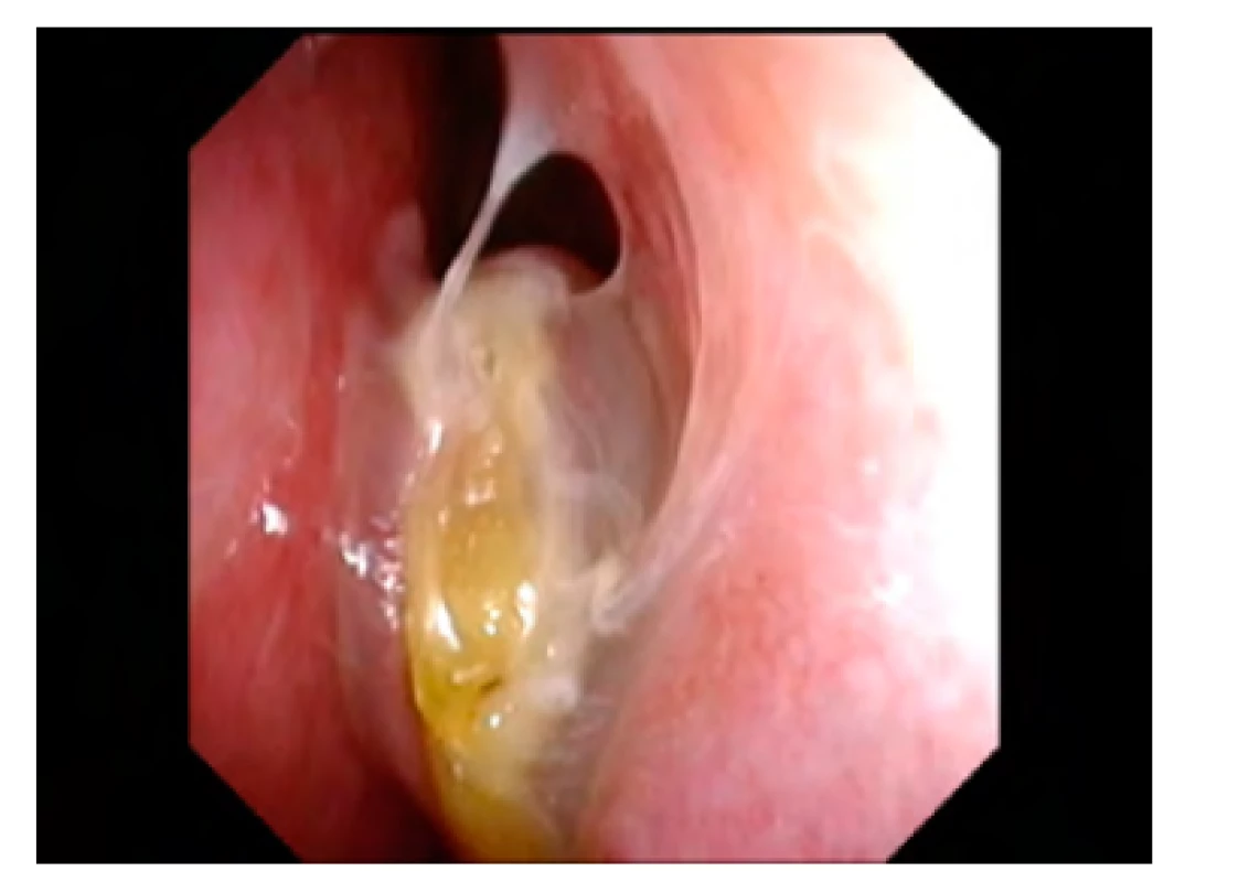 Chronická rinosinusitida s nosní
polypózou