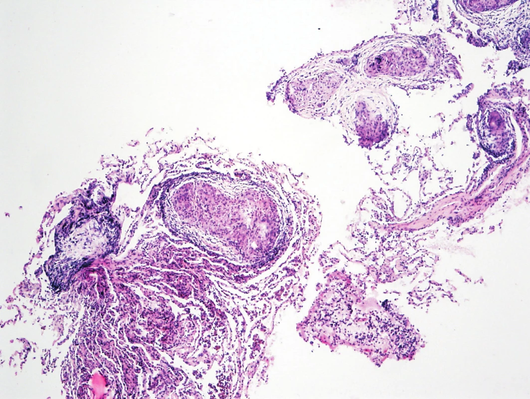 Histologie – epiteloidní granulom v plíci (archiv autorů
MUDr. M. Žurková, MUDr. T. Tichý)