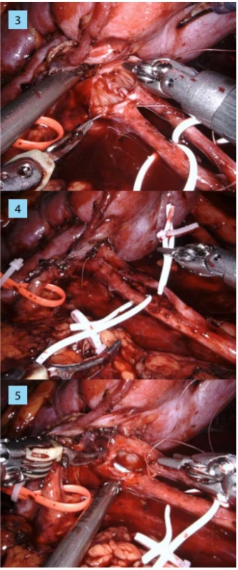 , 4, 5. Incize obou pánviček a následně jejich
anastomóza na stentu Ch6 pokračujícím, dlouhodobě
vstřebatelným stehem<br>
Fig. 3, 4, 5. Incision of both pelvises and their subsequent anastomosis on the Ch6 stent with a continuous, slowly absorbable suture