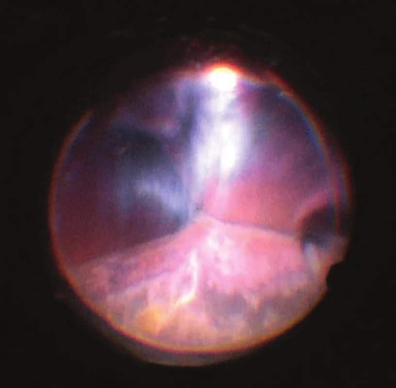 View of ocular fundus during the course of progressive
reduction of height of ablations, apposition of opposite
parts of retina gradually “unpeeled”, reflex from ocular
fundus begins to be visible. Light is reflected from vitreous
fibres which are squeezed into the retrolental space. Image
from perioperative video – from surgeon’s view