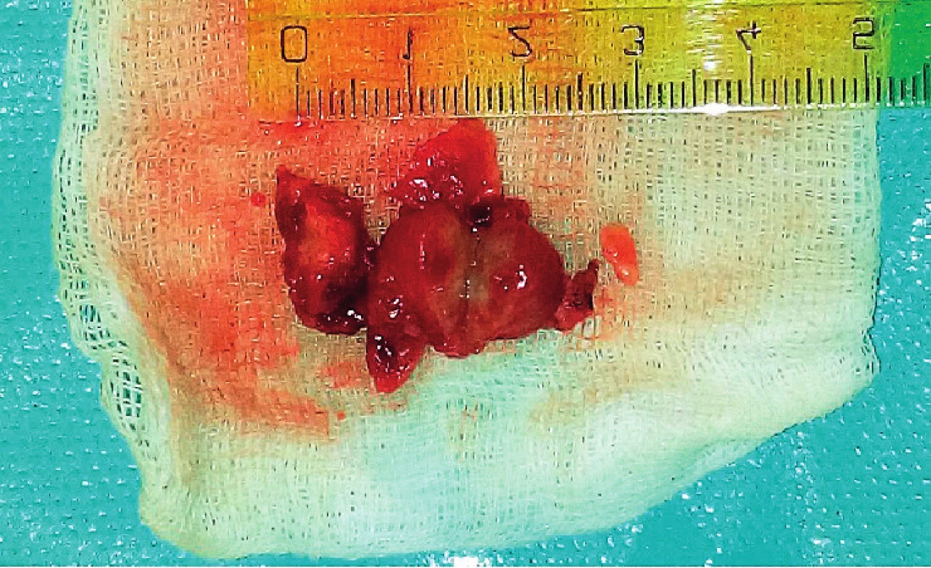 Lymfatická uzlina s abscesom a s granulómovým
zápalom.