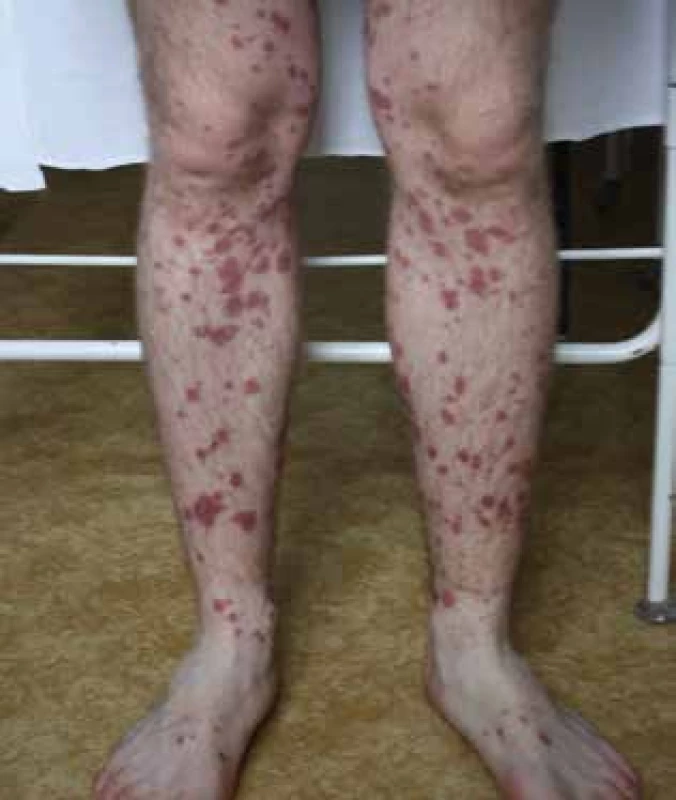 Vasculitis allergica po amoksiklave – leukocytoklastická
vaskulitída s palpovateľnou purpurou