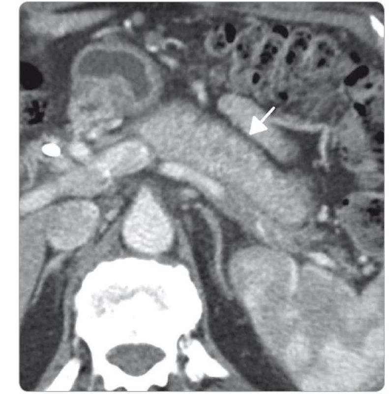 Capsule-like pankreatic rim – hypodenzní lem žlázy, „klobásovitý pankreas“ (CT
vyšetření s aplikací kontrastní látky).